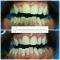 Igiene dentale professionale é sbiancamento click BLANCONE.